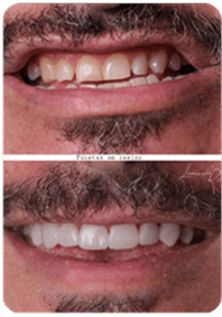 Paciente exibindo facetas dentárias