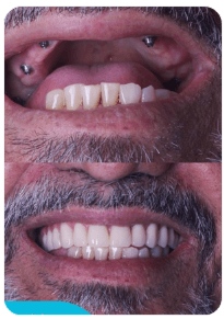 Paciente com implante dentário