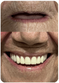 Paciente com prótese dentária